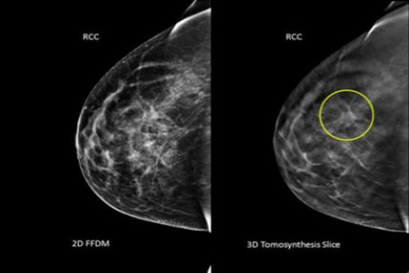 mammogram